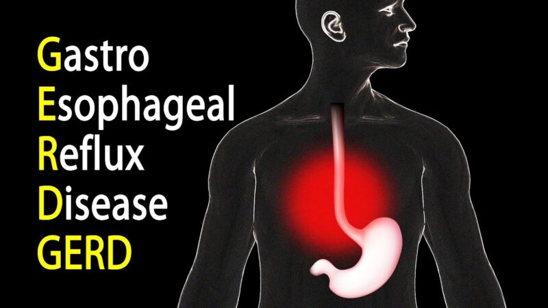 Acid Reflux syndrome