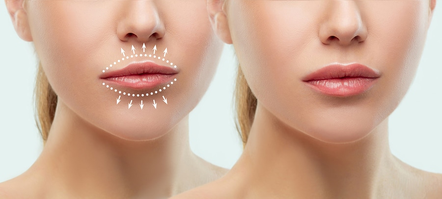 Lip Filling Treatment