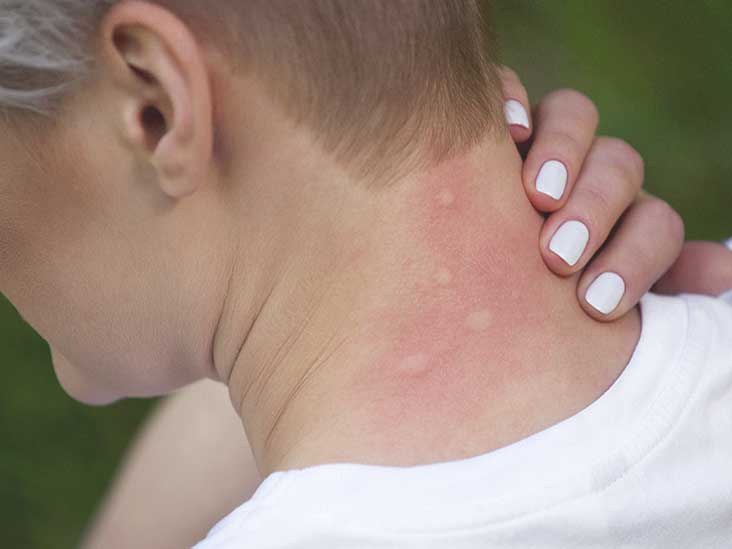 Bug Allergies