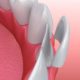 Upgrade Your Smile Top 5 Big Benefits Of Porcelain Veneers