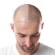 Micropigmentation Treatment